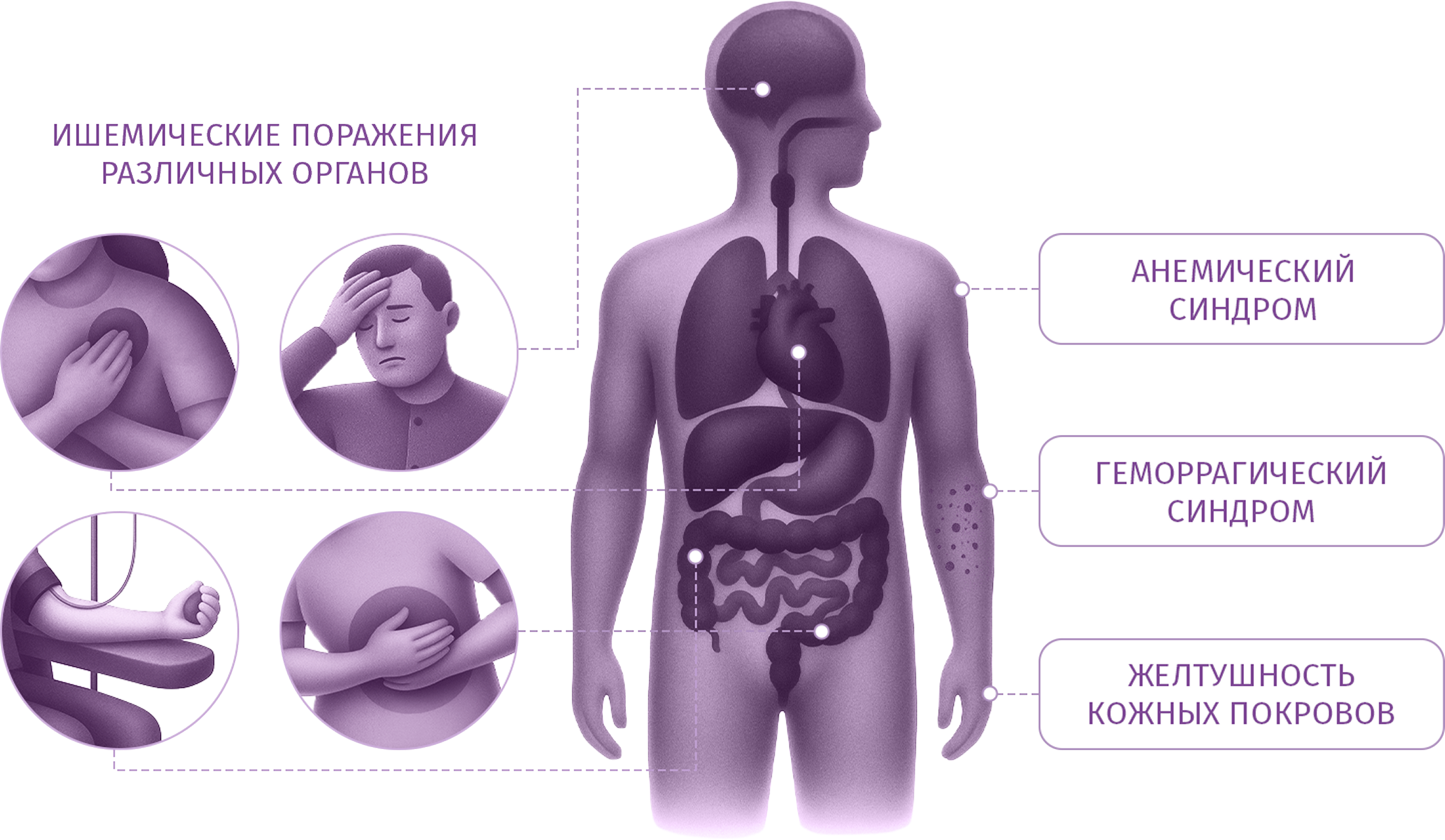 Схема поражения